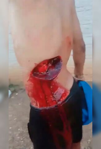 Man Shows Of His Rib Cage From Brutal Machete Wound