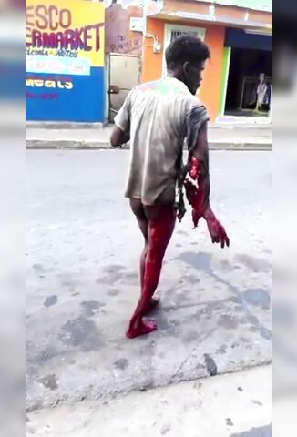 Man With A Completely Fucked Up Arm Wanders The Streets