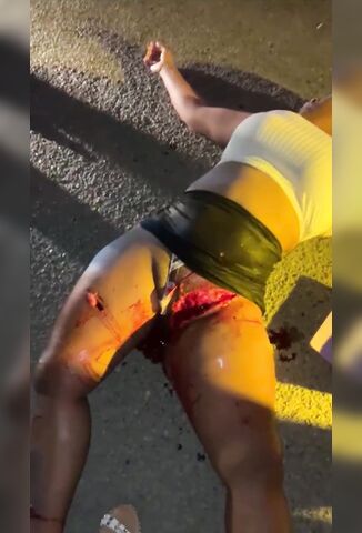 Savage - Girls Vagina Ripped Open From Brutal Accident