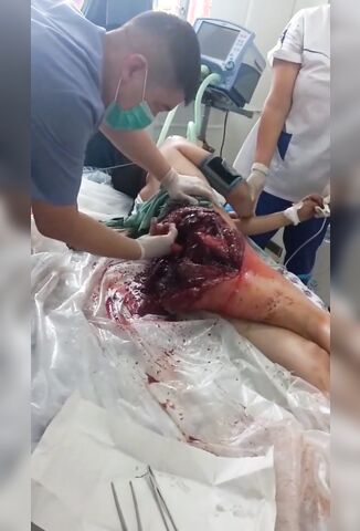 Girls Ass Exploded From Ass Implants