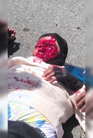 Rider Loses Half His Face In Brutal Accident Aftermath