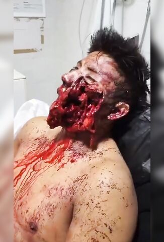 Shotgun To The Face Leaves Young Guy Disfigured For Life