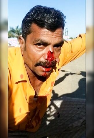 Bikers Nose Sliced Off In Accident