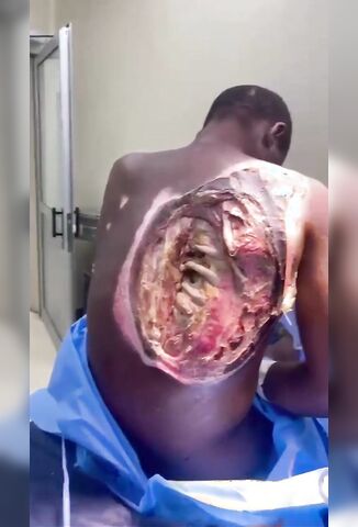 Man Is Almost See-through With Horrible Injury