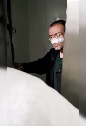 Man With His Entire Nose Missing Comes Out Of A Lift After 3 Days