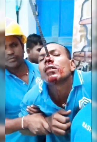 Man With A Rebar Embedded In His Face Looks Worried