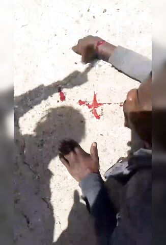 Mans Hand Chopped With A Machete In Africa