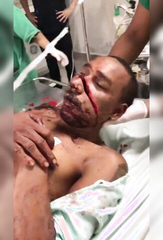 Machete To The Face Leaves Man With Two Mouths