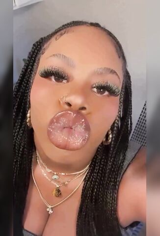 SMH Her New Lips Look Like An Asshole Puckering Up