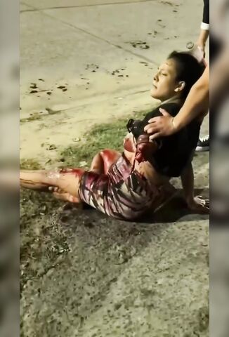 Calm Woman Had Her Arm Ripped Off In Motorcycle Accident