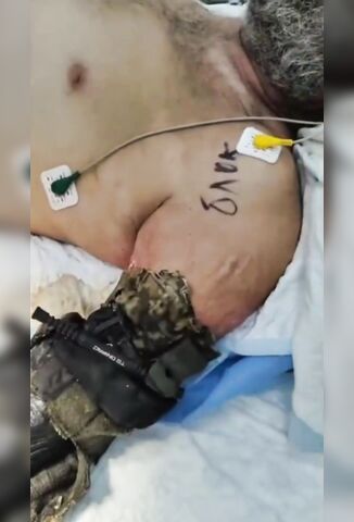 Soldier Tourniqued His Arm In The Field But Rescue Took 24 Days And His Arm Mummified