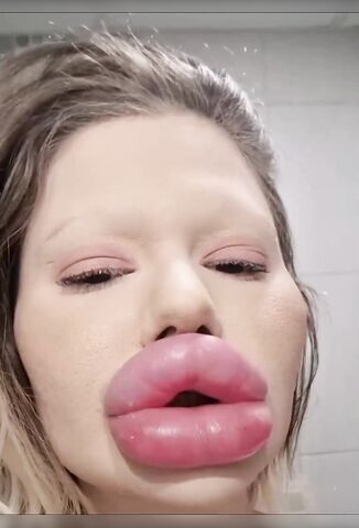 The Only Thing Those Lip Injections Are Good For