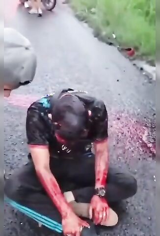 Poor Guy Faces Ripped Open From Bike Accident