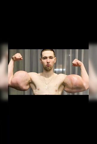 The Famous Russian Synthol Dudes Bicep Finally Exploded