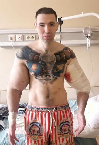 Russian Synthol Dude May End Up Losing His Hard Earned Arm